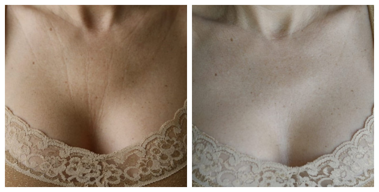 Resultado antes e depois de Maria